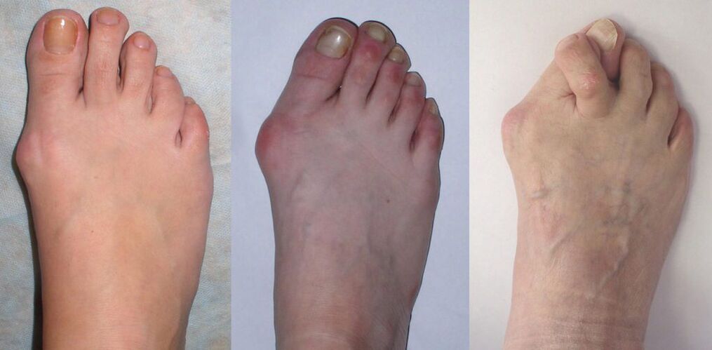 Arthritis of the foot