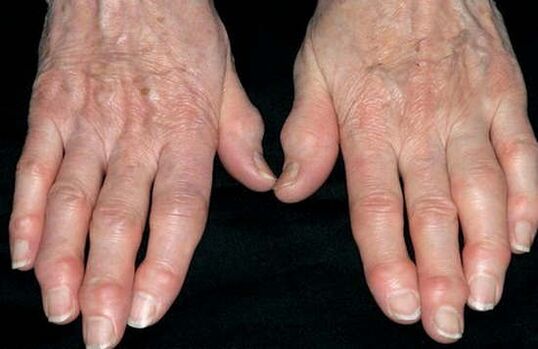 Arthrosis of the hands