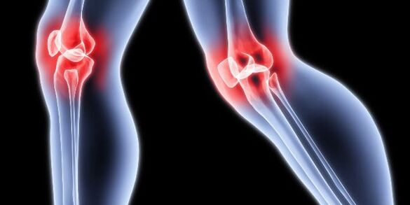 Arthrosis of the knee