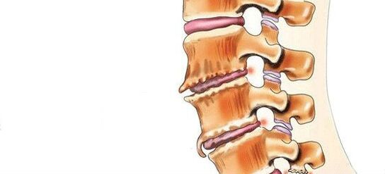 What is spondylosis