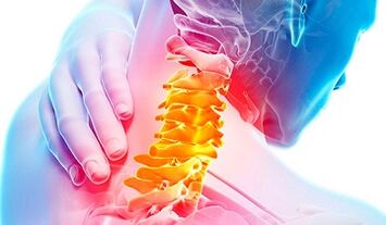 Signs of osteochondrosis of the cervical spine