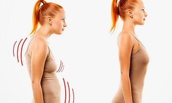 The reasons for the development of cervical osteochondrosis