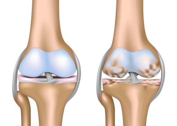What is gonarthrosis