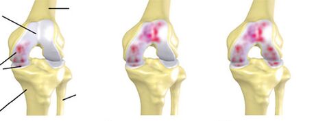 degree of arthrosis