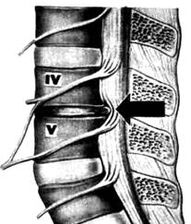 X -ray picture of the lumbar department of osteochondrosis
