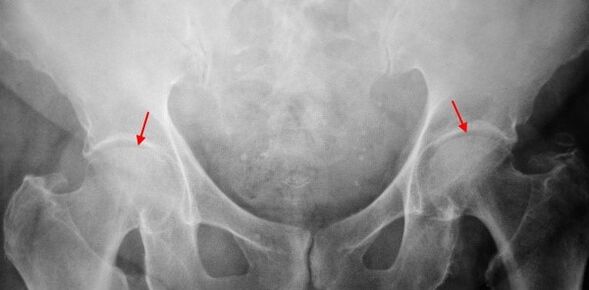 Double-sided coksartrosis-sustling of the joint gap, sclerosis of the articular surfaces