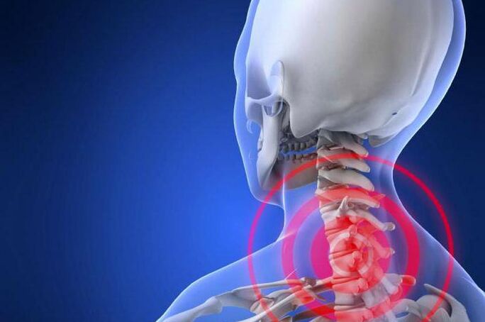 Shooting pain in the neck is an early symptom of cervical osteochondrosis
